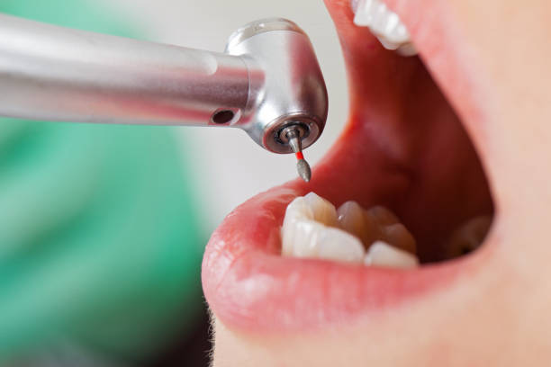 Best Emergency Root Canal Treatment in Tualatin, OR